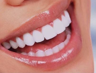 Clareamento Dental